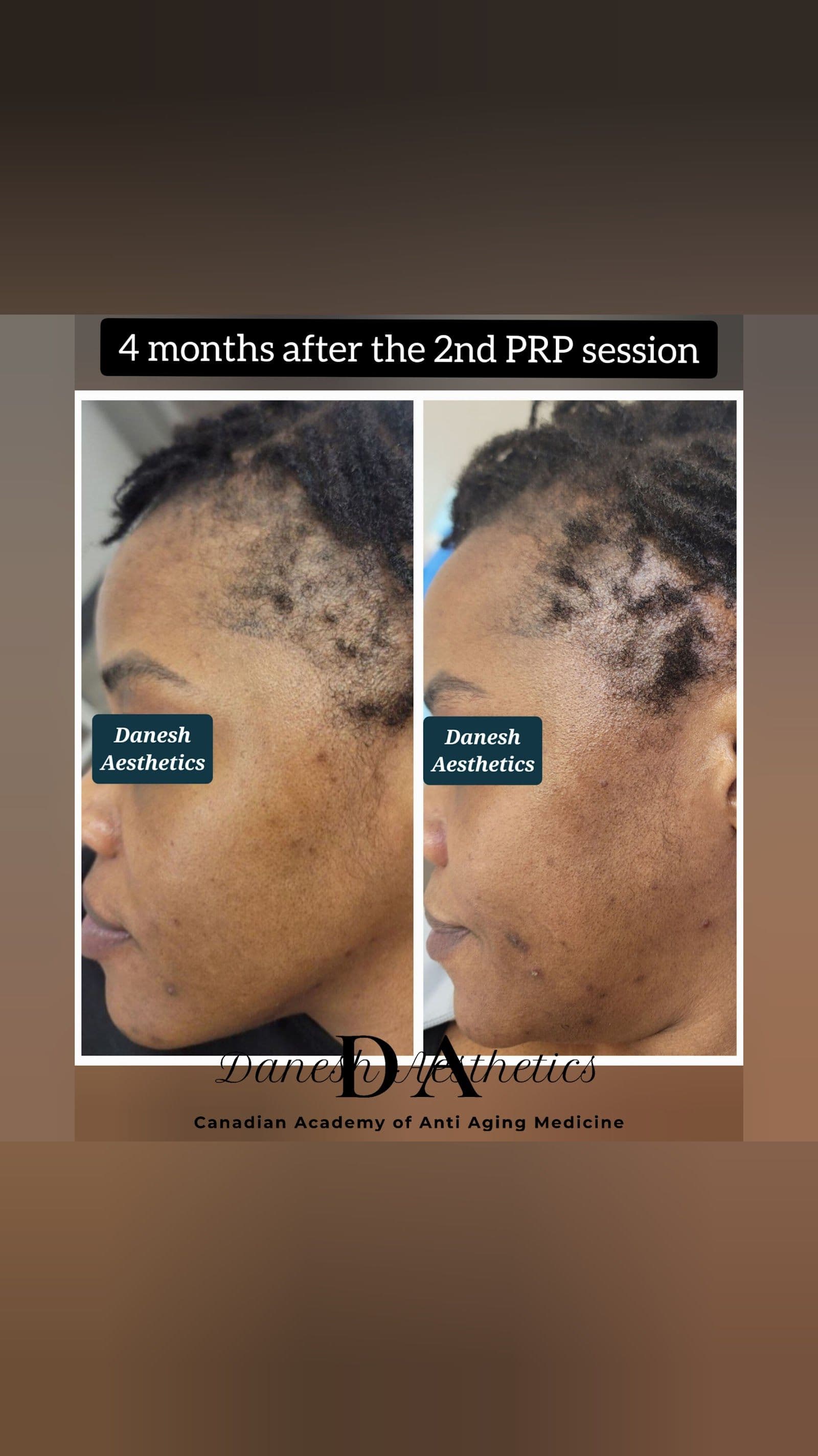 Guest photo from a Google review at Danesh Aesthetics Dr.M.Danesh ND (Dermatology-Focused)