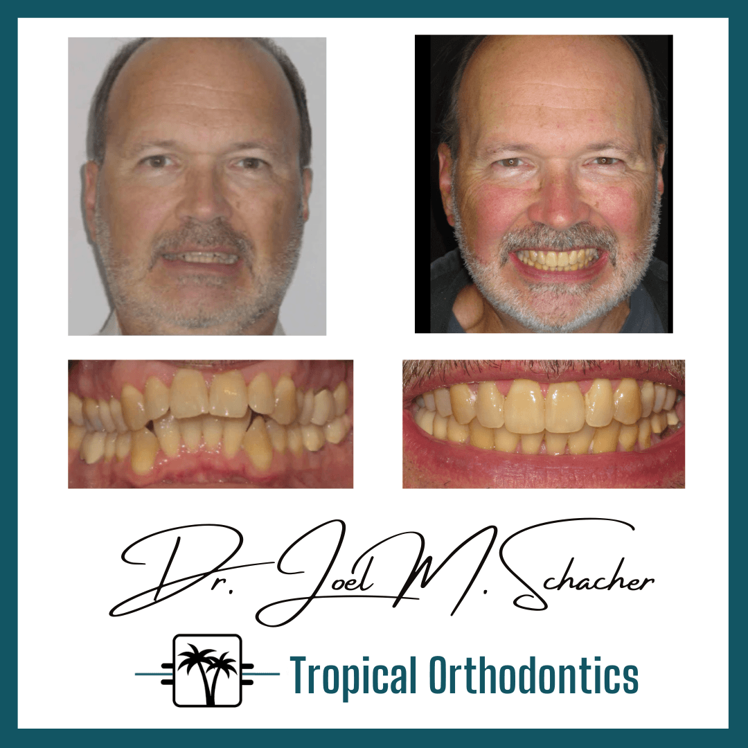 Another guest photo from a Google review at Tropical Orthodontics - Dr. Joel Schacher